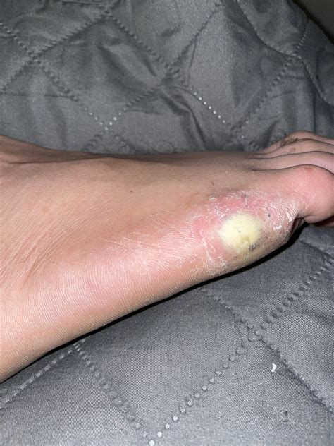 168 best Plantar Wart images on Pholder | Warts, Podiatry and