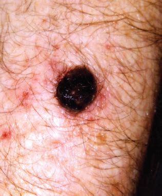 Nodular Melanoma | Consultant360