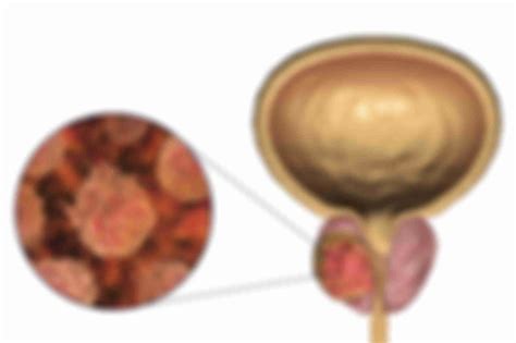 Prostate Cancer Genetics