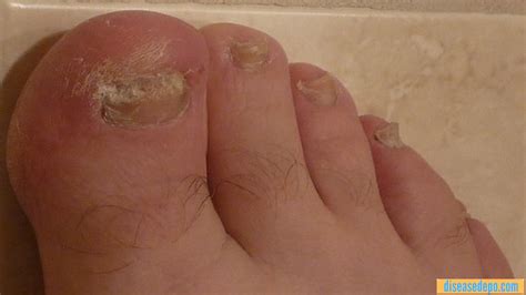 Fungal nail infection