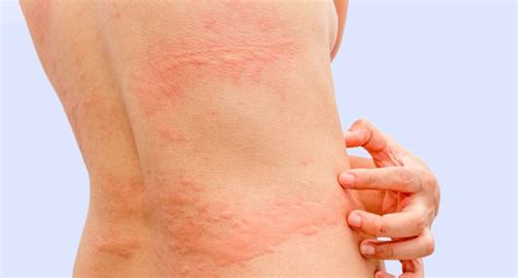 O Que Pode Causar Alergia Na Pele - 6 causas comuns de alergia na pele