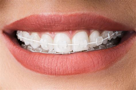 Clear Braces Southbourne - Teeth Aligners Bournemouth