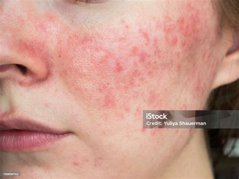 Rosacea Causes and Prevention Tips | Su-Skin | Fort Myers, FL