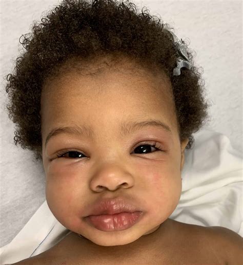 allergic reaction face vrogueco