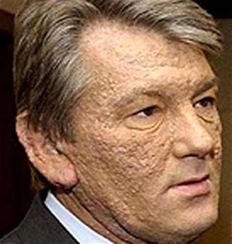 Проказа Болезнь Фото — Фото Картинки