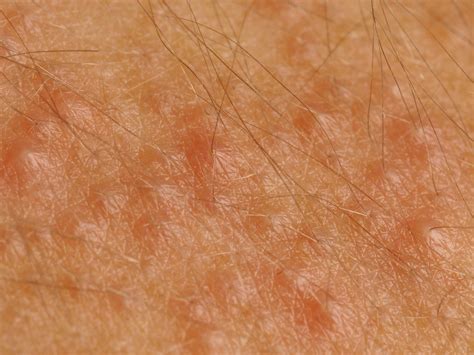 malassezia folliculitis - pictures, photos