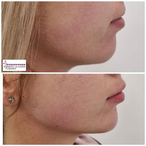 👉Корекция на долна челюст,... - Haydudova Esthetic Center