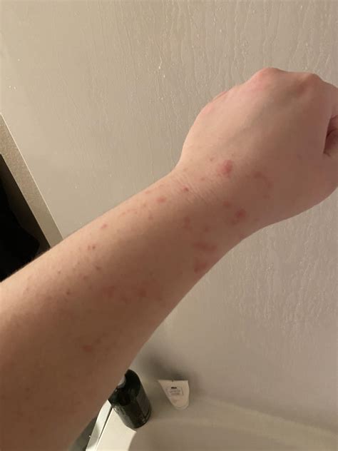 Lamictal Rash on 50mg : r/bipolar2