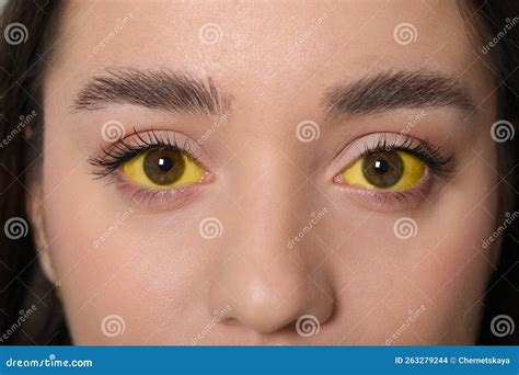 Woman with Yellow Eyes, Closeup. Symptom of Hepatitis Stock Photo ...