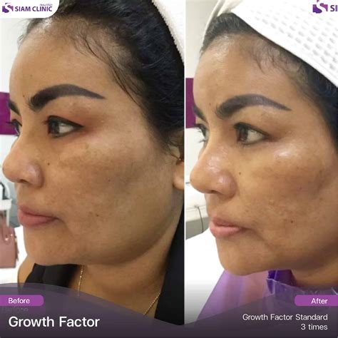 Growth Factor Therapy - Siam Clinic - Aesthetic & Wellness Clinic in Phuket