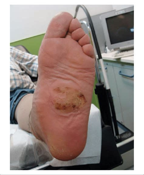 Pictures Of Charcot Foot - What is Charcot foot? - WCEI Blog WCEI Blog ...