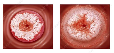cervical cancer drawing stock image  science photo library