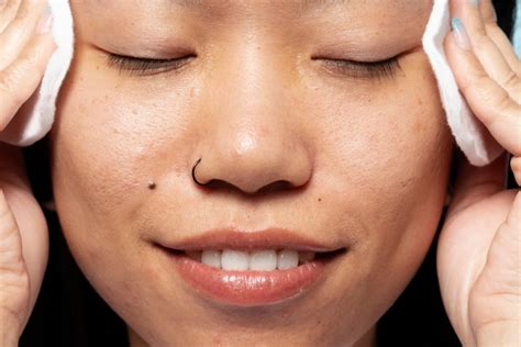 safe mole removal  singapore  doctor