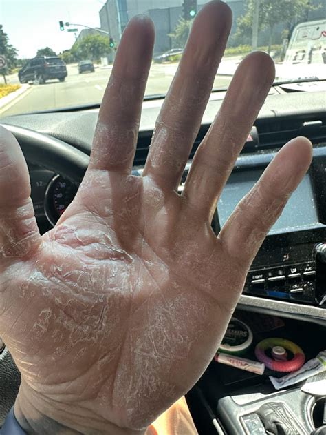 Fungal infection on hand or eczema? : r/Dermatology