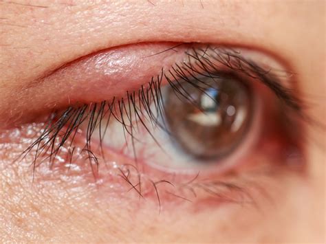 es la blefaritis como prevenirla  como tratarla clinica