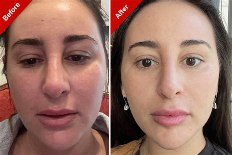 Ozempic Face: Before And After Considerations