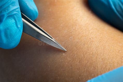 Process of Permanent Hair Removal, Removing Unwanted Hair Using an ...