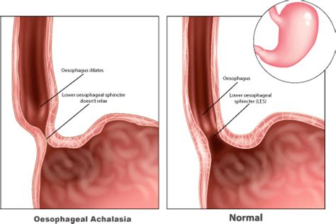 Achalasia & Heller Myotomy | Achalasia | Heller Myotomy | UGIRS