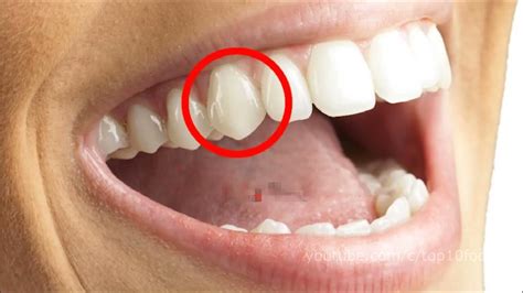 top 10 dentes - YouTube