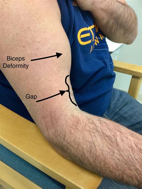 Do Biceps Tendon Tears Require Surgery?