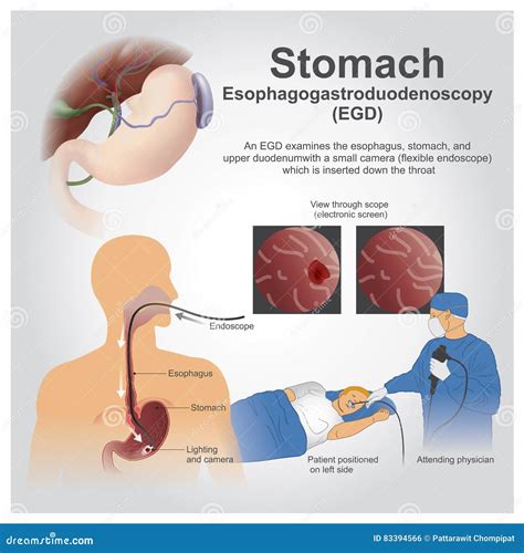 Maag vector illustratie. Illustration of bacterieel, spijsverterings ...