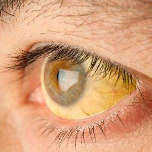 Botkin's disease in children: symptoms and children - Medical diagnosis