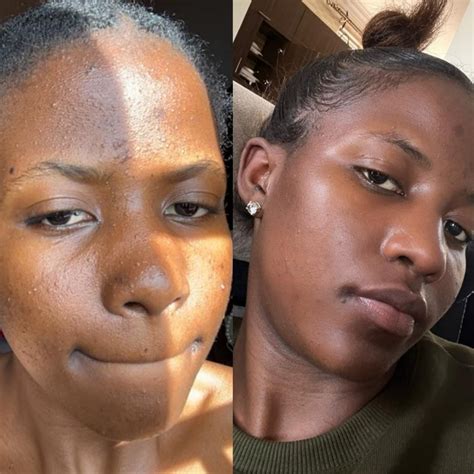 Acne and pimple serum