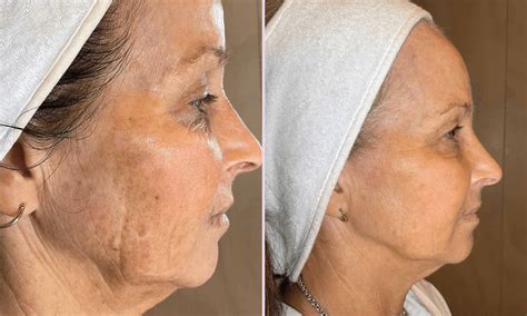 Moxi & BBL Stack | BBL Moxi Treatment - Eden Medical Clinic