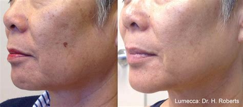IPL Lumecca — SLC Med Spa