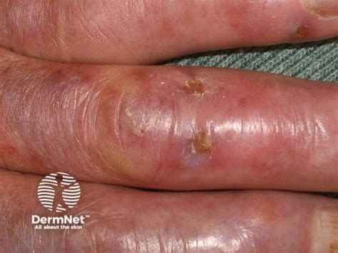 chilblains image