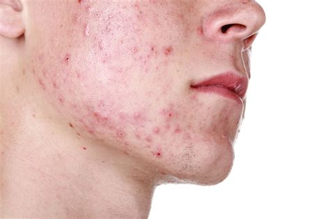 acne conglobata todo lo  debes saber muy salud