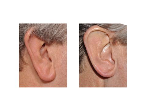 New Technique in Earlobe Reduction Surgery - Explore Plastic Surgery