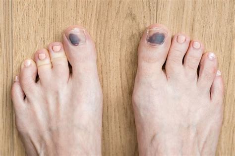 5 Ways to Prevent Runner's Toe : Neuhaus Foot & Ankle: Podiatry