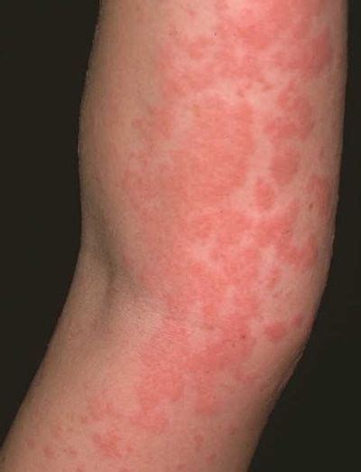Alergia al Marisco | Gluten allergy, Gluten allergies symptoms, Skin ...