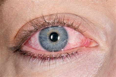 Episcleritis - Stock Image - C037/0938 - Science Photo Library