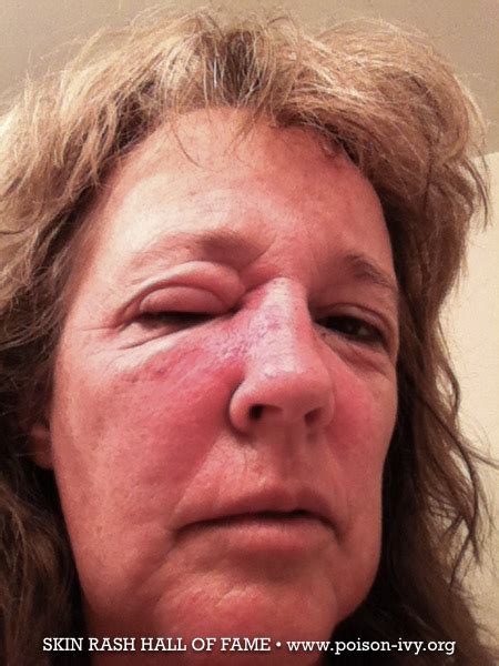 Bad Poison Ivy Face Rash - poison-ivy.org