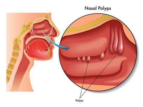 Nasal Polyps And Afrin at Natasha Cain blog