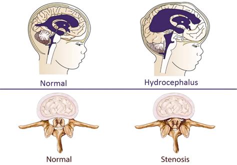 Achondroplasia | Causes, Signs, Standard Therapies, Prevention in ...