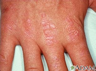 Dermatomyositis - Gottron's papules on the hand: MedlinePlus Medical ...