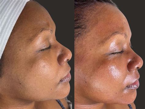Hydrafacial NYC - Results, Costs & Benefits
