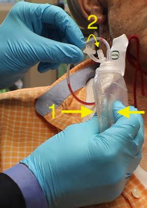 care technique jp drain  surgery doctorlansfordcom