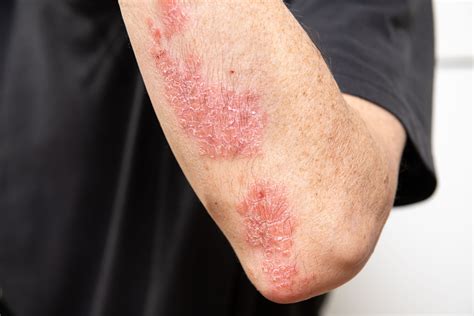 Psoriasis