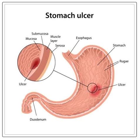 Stomach Ulcers: Causes, Symptoms, and Treatment - REPC