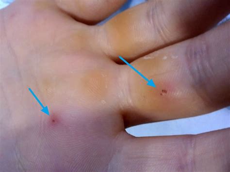 Janeway lesions, Osler nodes, splinter hemorrhages & Roth spots