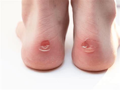 Bolhas Pequenas Nos Pés - O que fazer com bolhas nos pés?