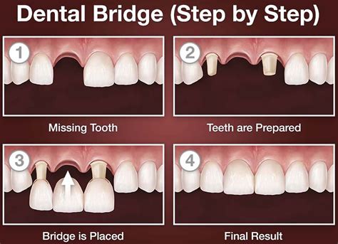 Missing Teeth, Dental Bridge, Quick