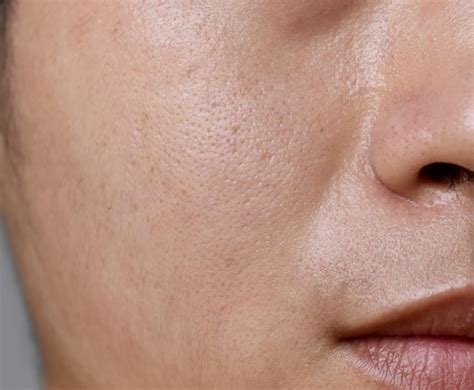 Premium Photo | Fair skin with wide pores in face of Southeast Asian ...