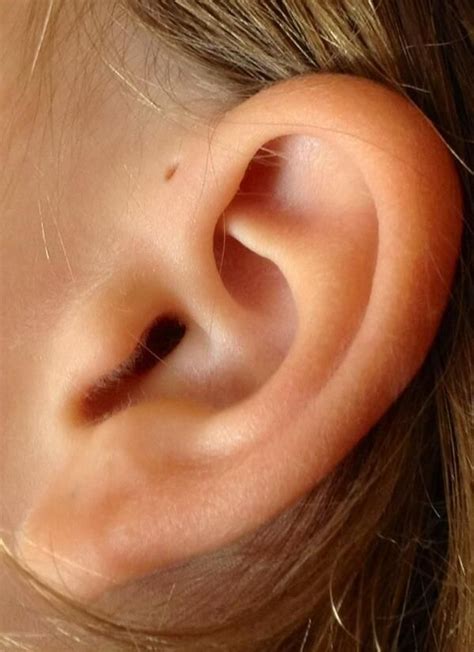 preauricular cyst excision