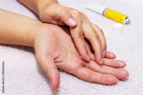 Eczema on the hands. The woman applying the ointment , creams in the ...