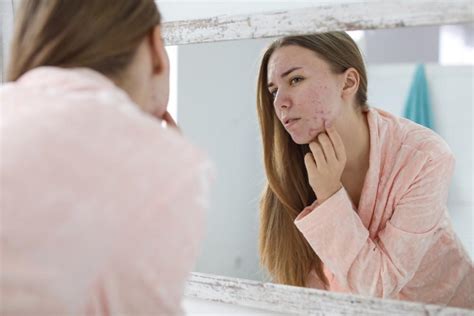 Top 5 Reasons Popping Your Zits Can Cause More Harm Than Good - Hunter Games Magazine